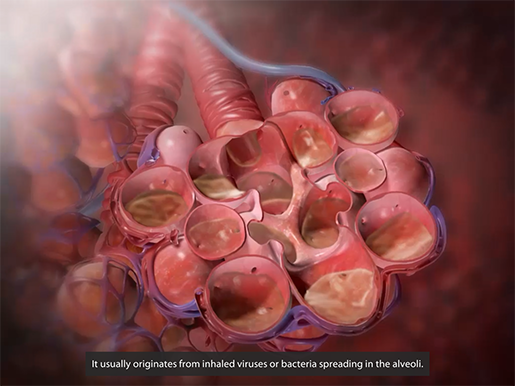 respiratory-pathologies-pneumonia