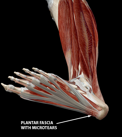 plantar-fasciitis-plantar-fascia-microtears