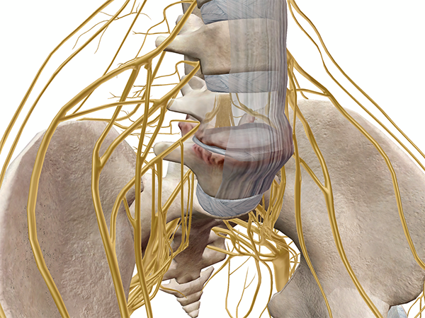 collapsed-intervertebral-disc-muscles-kinesiology