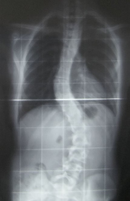 scoliosis-scan-public-domain