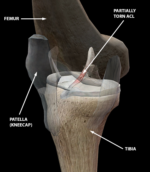 sports-injuries-acl-tear-knee-sprain-w