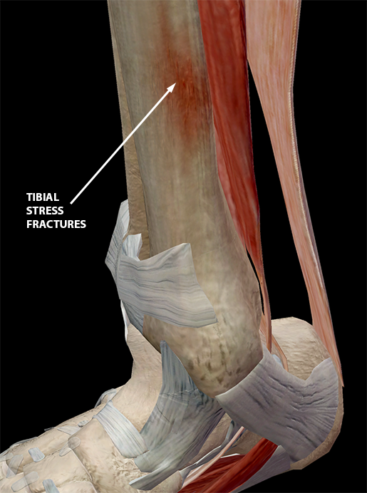 Sports Injury Bulletin - Anatomy - Driving a wedge between orthotics and  illiotibial band strain