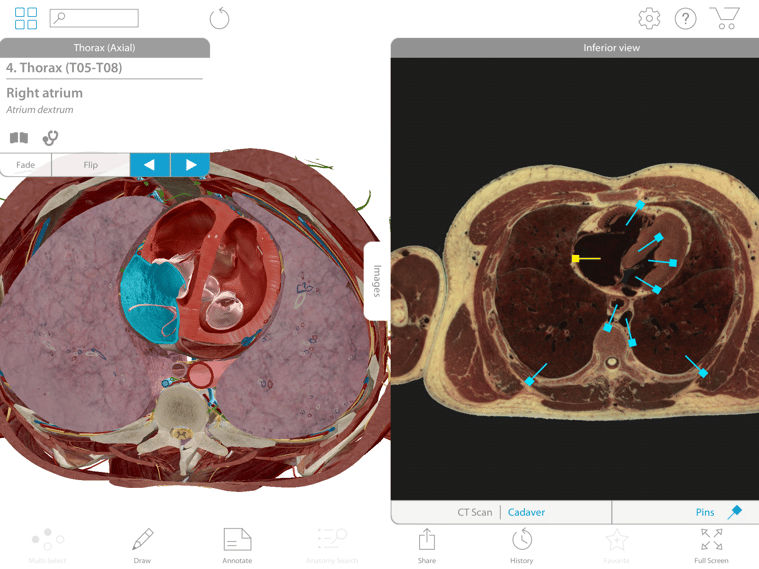 Comparing a 3D cross section with a cadaver scan