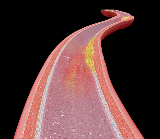 atherosclerosis-physiology-and-pathology