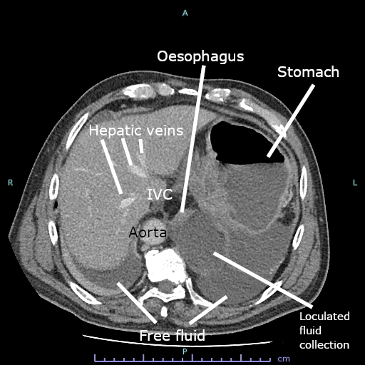 CT_scan_of_fluid_collection_at_gastro-oesophageal_junction