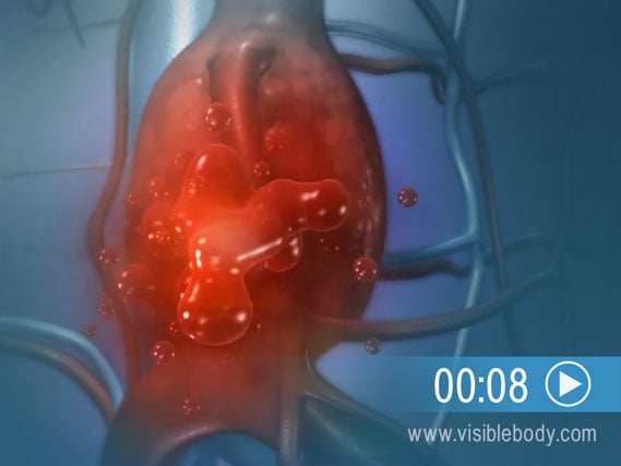 Click to play an animation of a bulging aorta from an abdominal aneurysm.