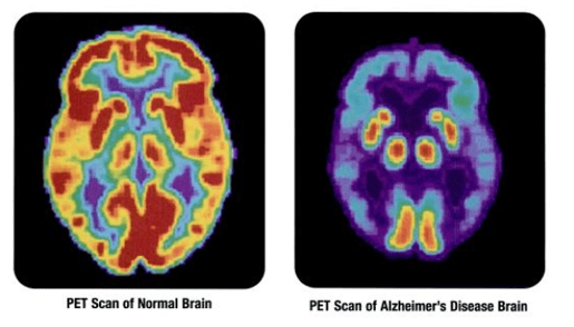 PET_scan-normal_brain-alzheimers_disease_brain