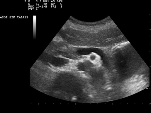 Ultrasound_image_of_pancreas_110316091246_0916180