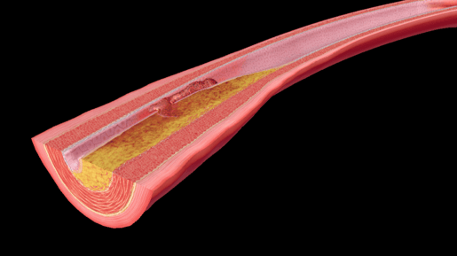 atherosclerosis