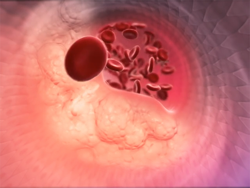 cholesteral3
