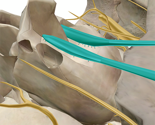 ethmoid5