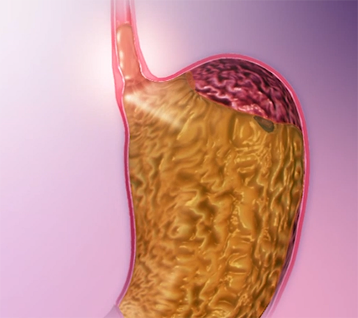 gerd1