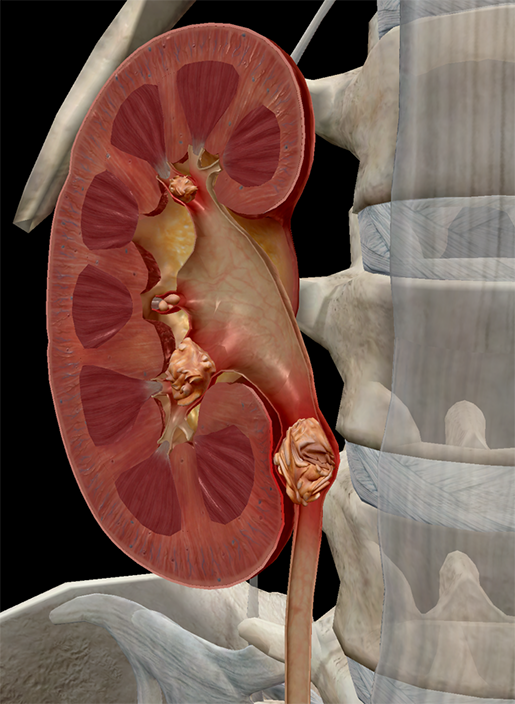 Painful Pebbles: The Anatomy and Pathology of Kidney Stones