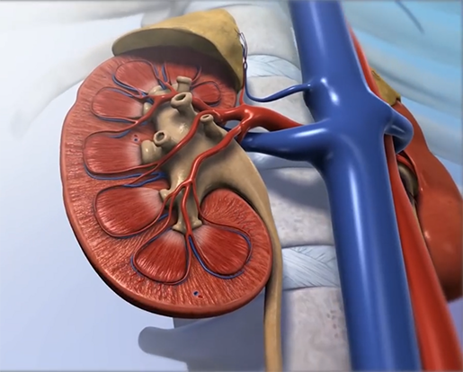 kidneystone1