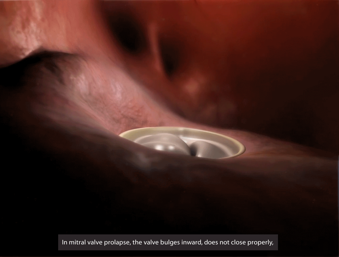 mitral-valve-prolapse-gif