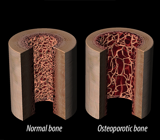 Brittle bones. Несовершенный остеопороз 3 Тип. Несовершенство остеопороза. Нарушенный остеогенез. Несовершенное костеобразование.
