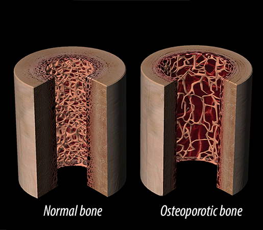 normal-healthy-bone-osteoporotic