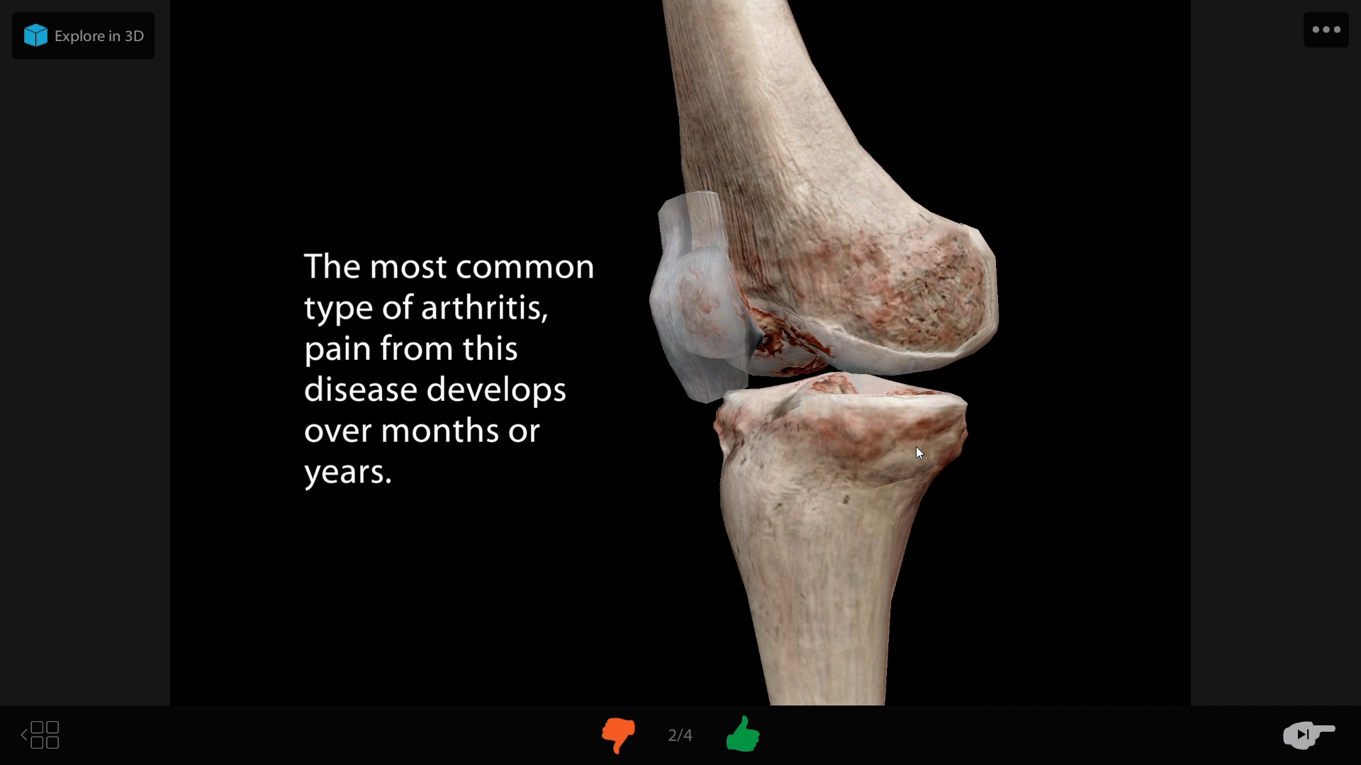 osteoarthritis-flashcard