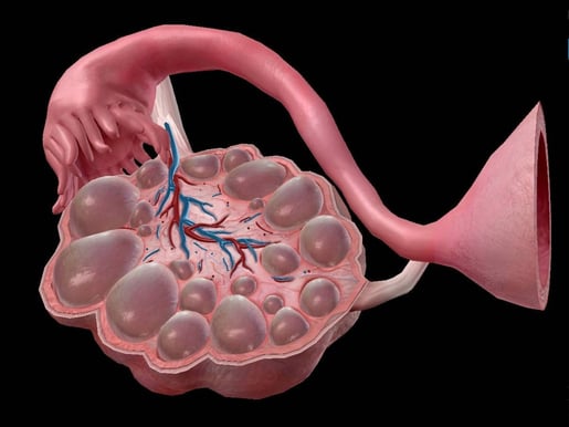 pcos model