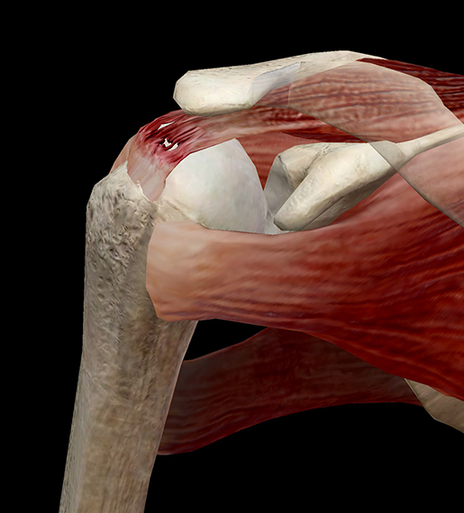 Rotator Cuff Tear Diagram