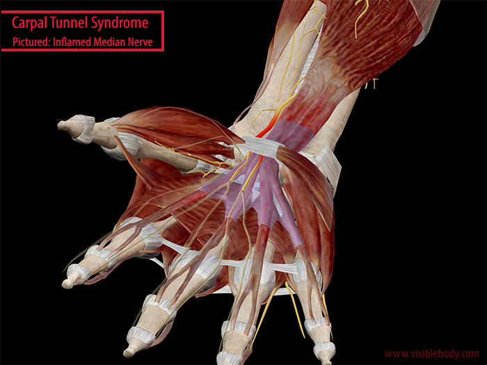 Into The Carpal Tunnel Anatomy & Pathology of Carpal Tunnel Syndrome
