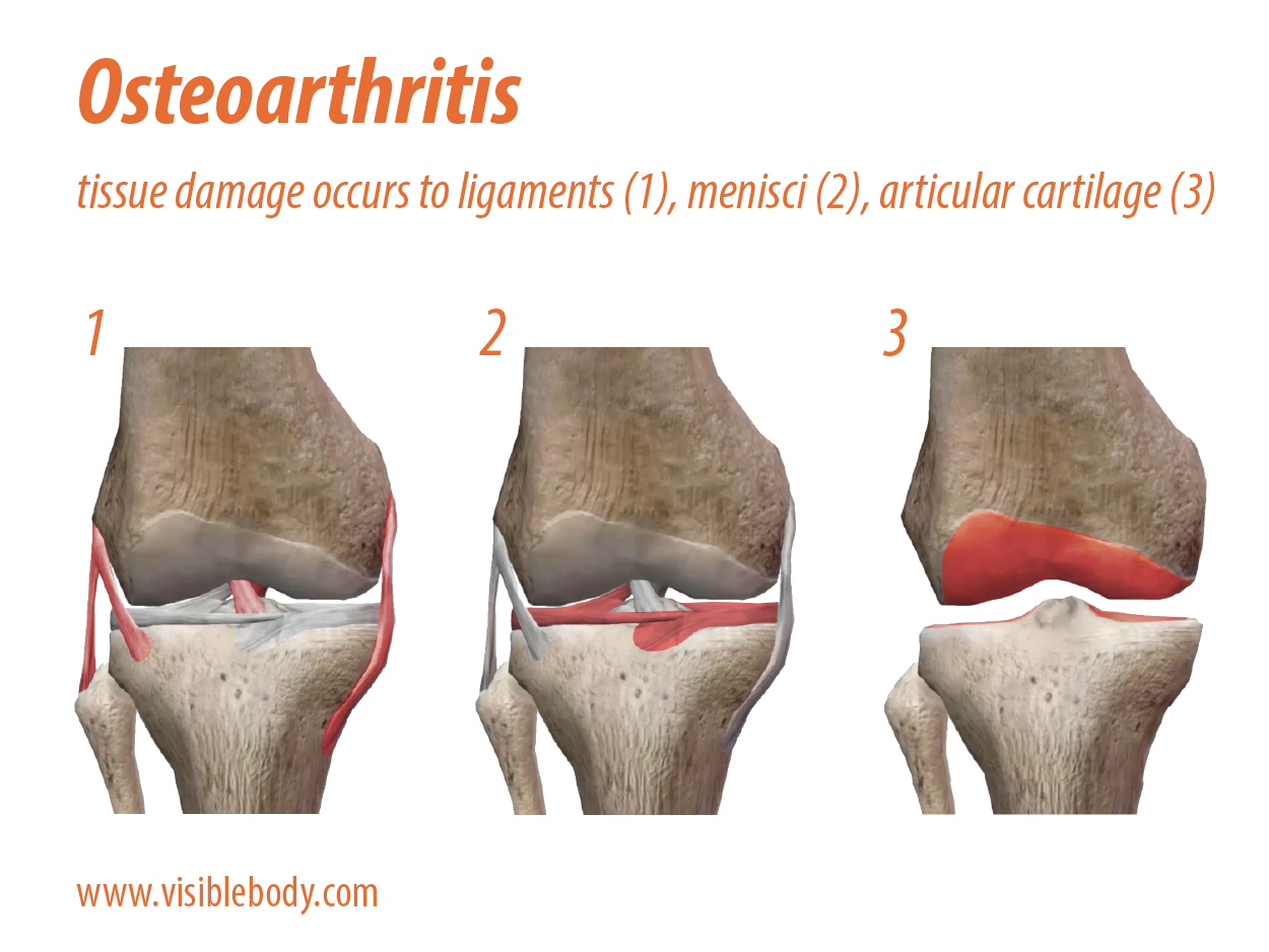 New Year, New Me, Old Knees Degenerated Articular Cartilage (Osteoarthritis)