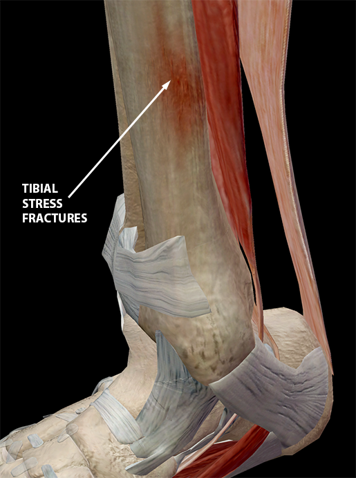 Omkleden krater Datum Hold on to Your Tibias: The Anatomy and Causes of Shin Splints