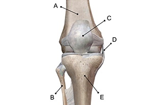 ACL Tear