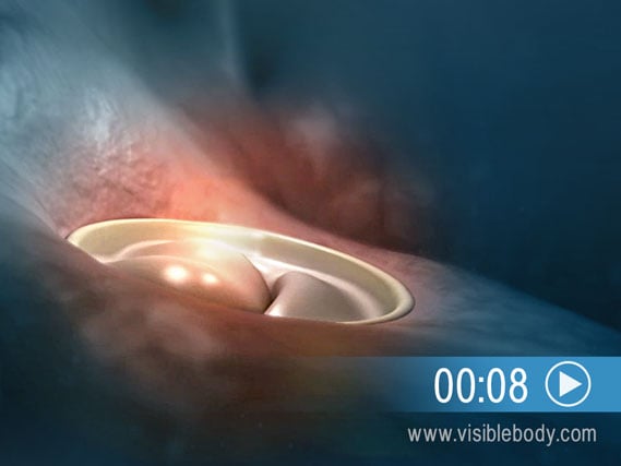 Click to play an animation of mitral valve prolapse