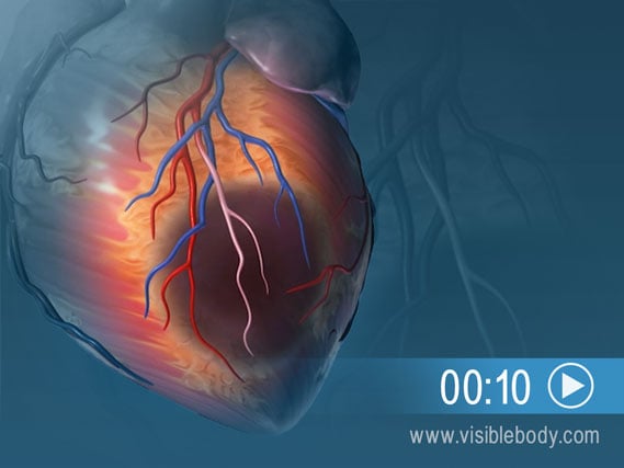 Animation illustrant les lésions au tissu cardiaque dues à un infarctus du myocarde