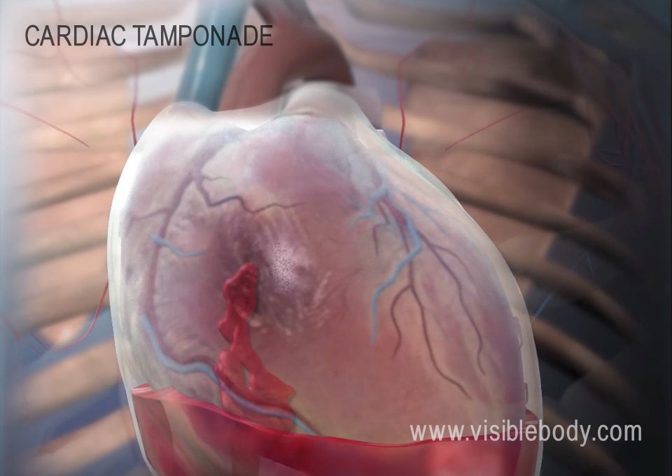 Cardiac tamponade is when fluid in the pericardium puts pressure on the heart.