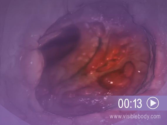 Haga clic para ver una animación de la colitis ulcerosa