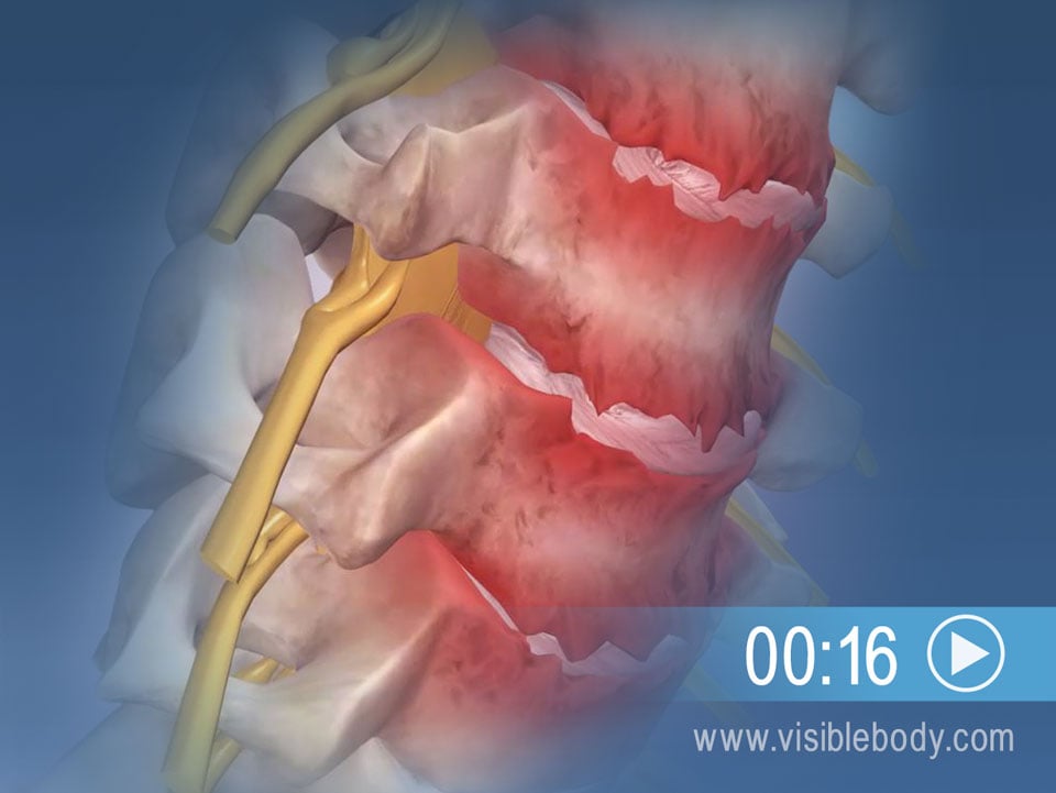 Knorpeldegeneration kann im Verlauf zur zervikalen Spondylose führen