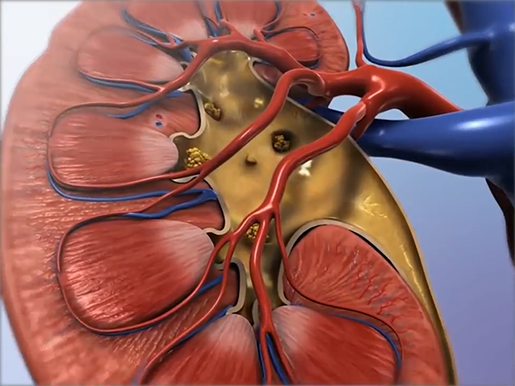 Painful Pebbles: The Anatomy and Pathology of Kidney Stones