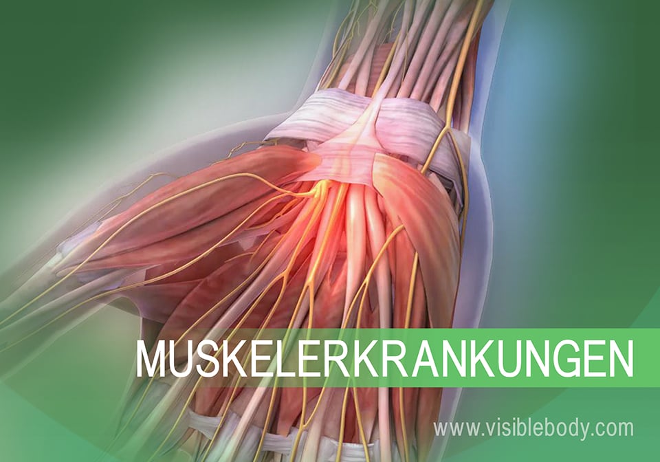 Erkrankungen des Muskelsystems: Häufige Erkrankungen und Beschwerden