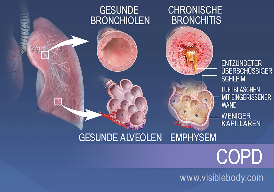 Bei Patienten mit chronischer Bronchitis sind die Bronchiolen entzündet und produzieren zu viel Schleim. Bei Patienten mit Lungenemphysem sind die Lungenbläschen zerrissen und weisen weniger Kapillaren auf.