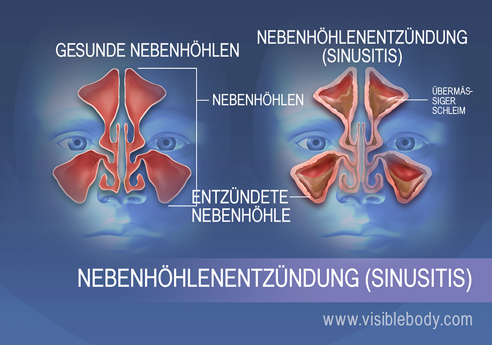 Die Nebenhöhlen von Patienten mit einer Sinusitis produzieren zu viel Schleim und ihre Innenwände sind entzündet