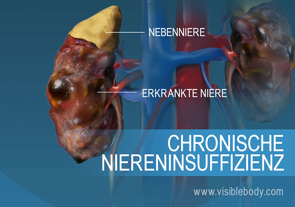 Vergleich gesunder und erkrankter Nieren
