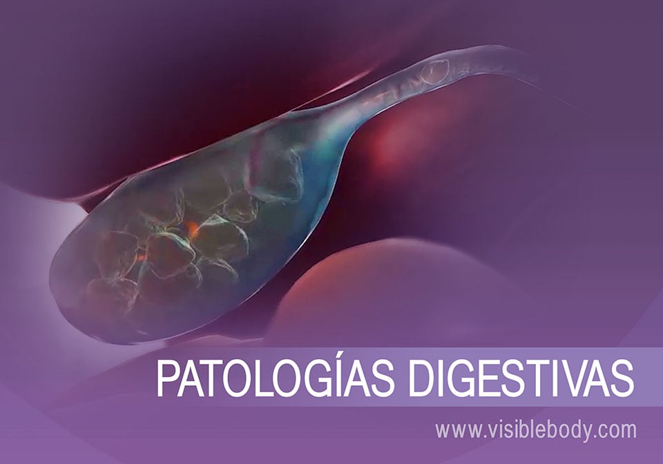 Cálculos biliares y ejemplo de una patología digestiva