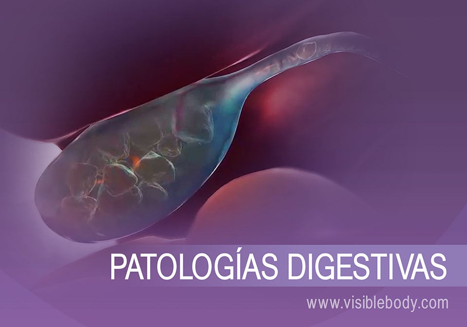 Calculs biliaires et exemple de pathologie digestive