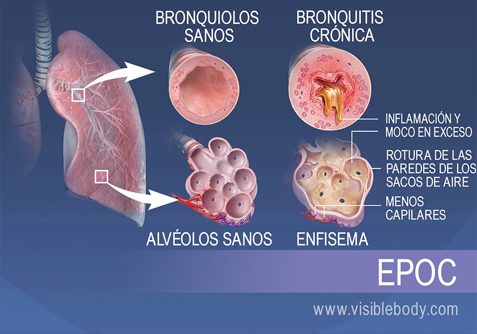 Los bronquíolos de las personas con bronquitis crónica están inflamados y tienen una cantidad excesiva de moco. Los alvéolos de las personas con enfisema están destruidos y tienen menos capilares