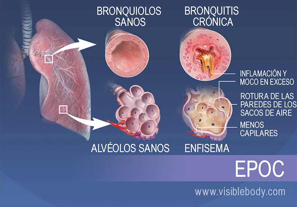 Los bronquíolos de las personas con bronquitis crónica están inflamados y tienen una cantidad excesiva de moco. Los alvéolos de las personas con enfisema están destruidos y tienen menos capilares