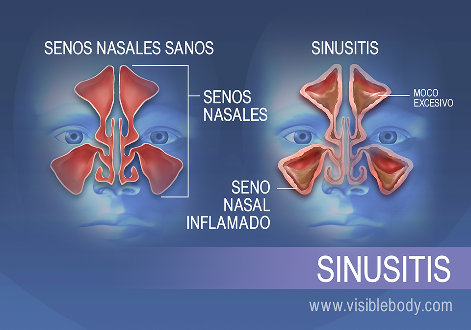 Los senos nasales de las personas con sinusitis tienen moco en exceso y las paredes de los senos están inflamadas