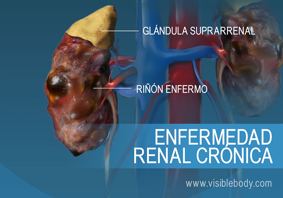 Comparación de riñones sanos y enfermos