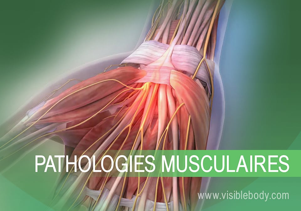 Pathologies du système musculaire : Troubles et pathologies courants