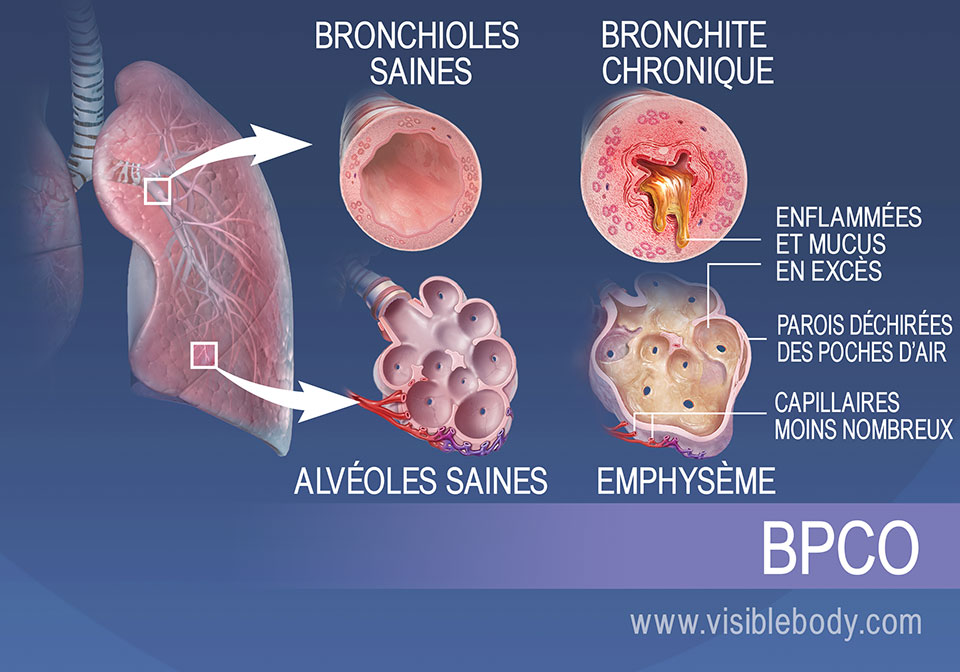 Les bronchioles des personnes souffrant de bronchite chronique sont enflammées et produisent trop de mucus. Les alvéoles des personnes souffrant d'emphysème sont déchirées et présentent moins de capillaires.