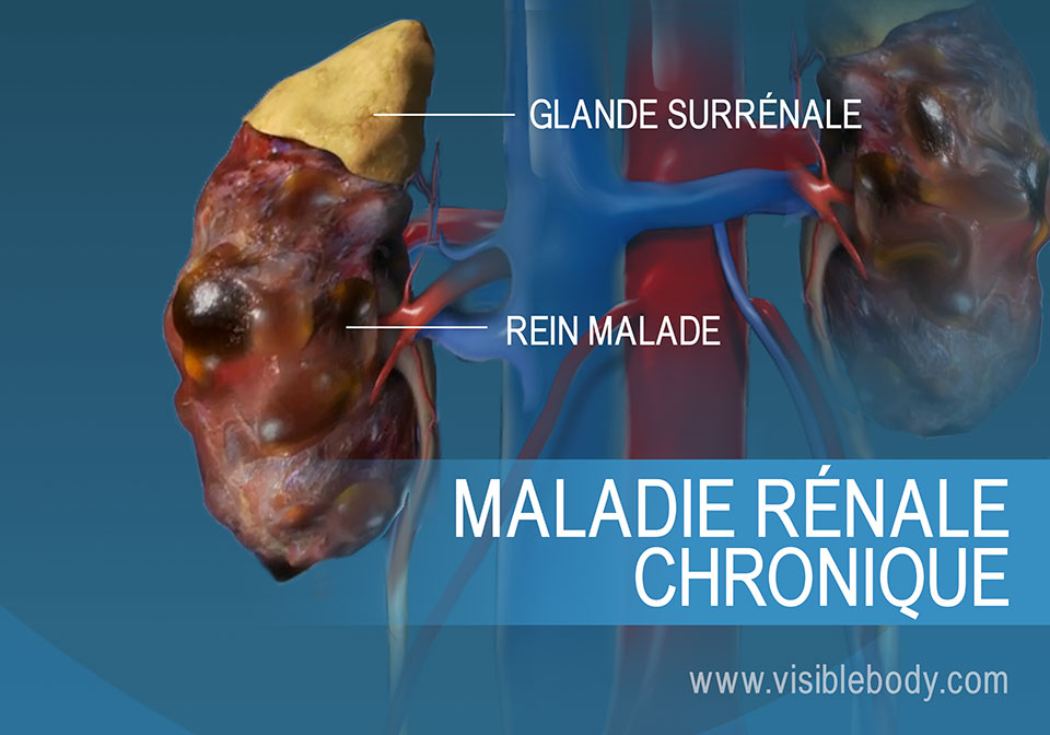 Comparaison entre des reins sains et malades