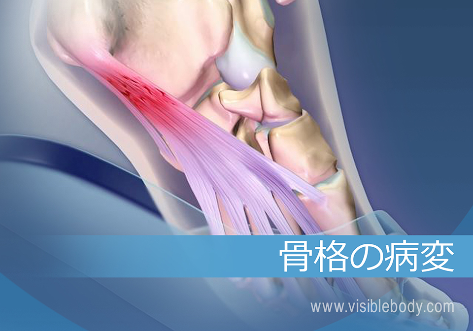 以下に説明する病理変化が、ストレスと加齢が骨格系を冒すと起こる可能性があります。