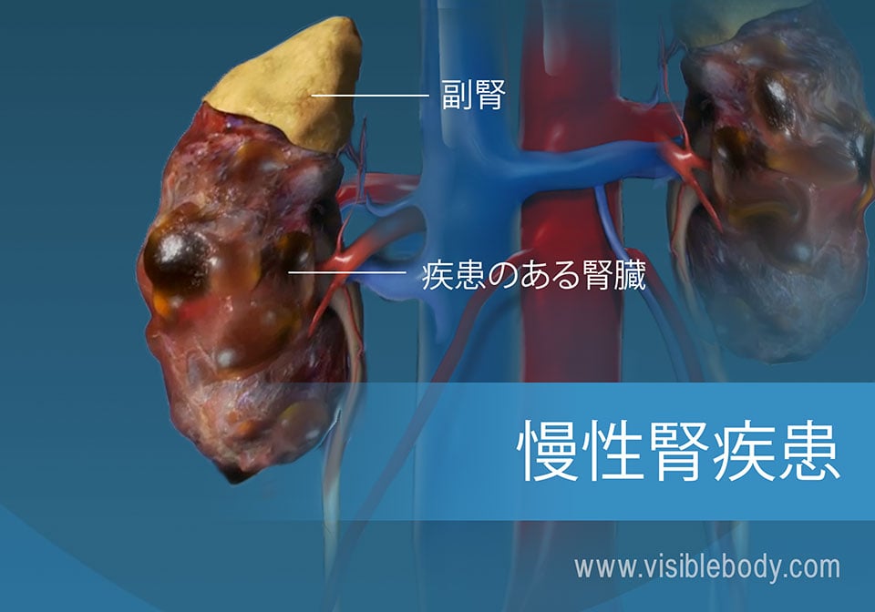 健康な腎臓と疾患のある腎臓との比較