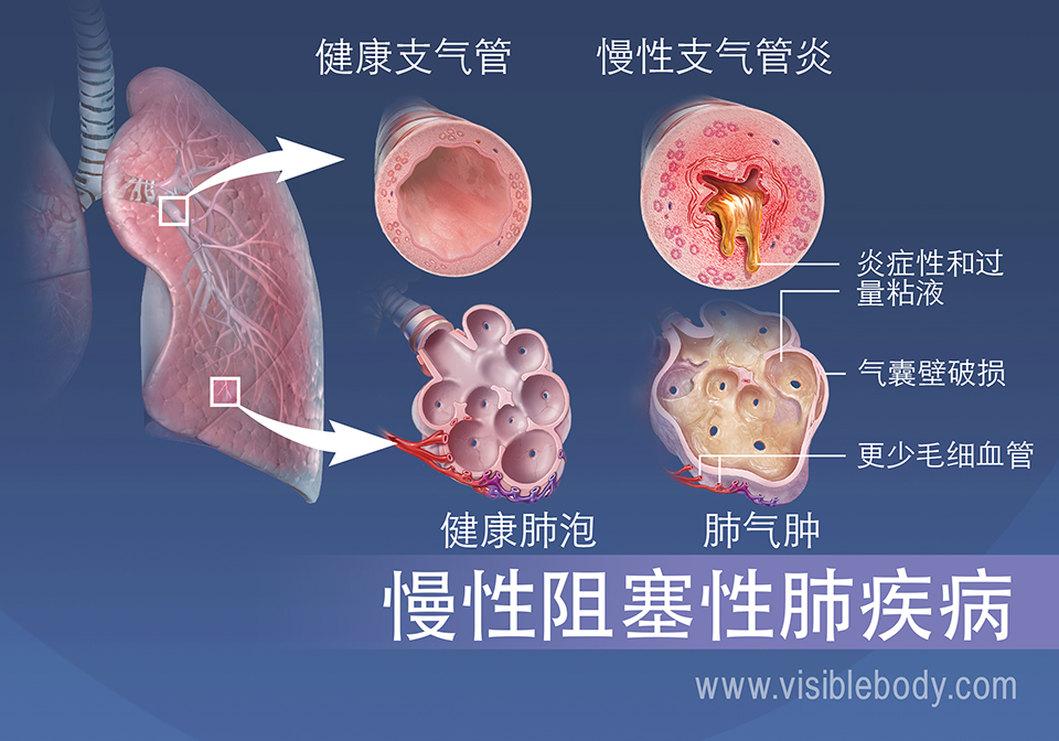 患有慢性支气管炎的人的细支气管发炎并且粘液过多。 肺气肿患者的肺泡被撕裂，毛细血管减少